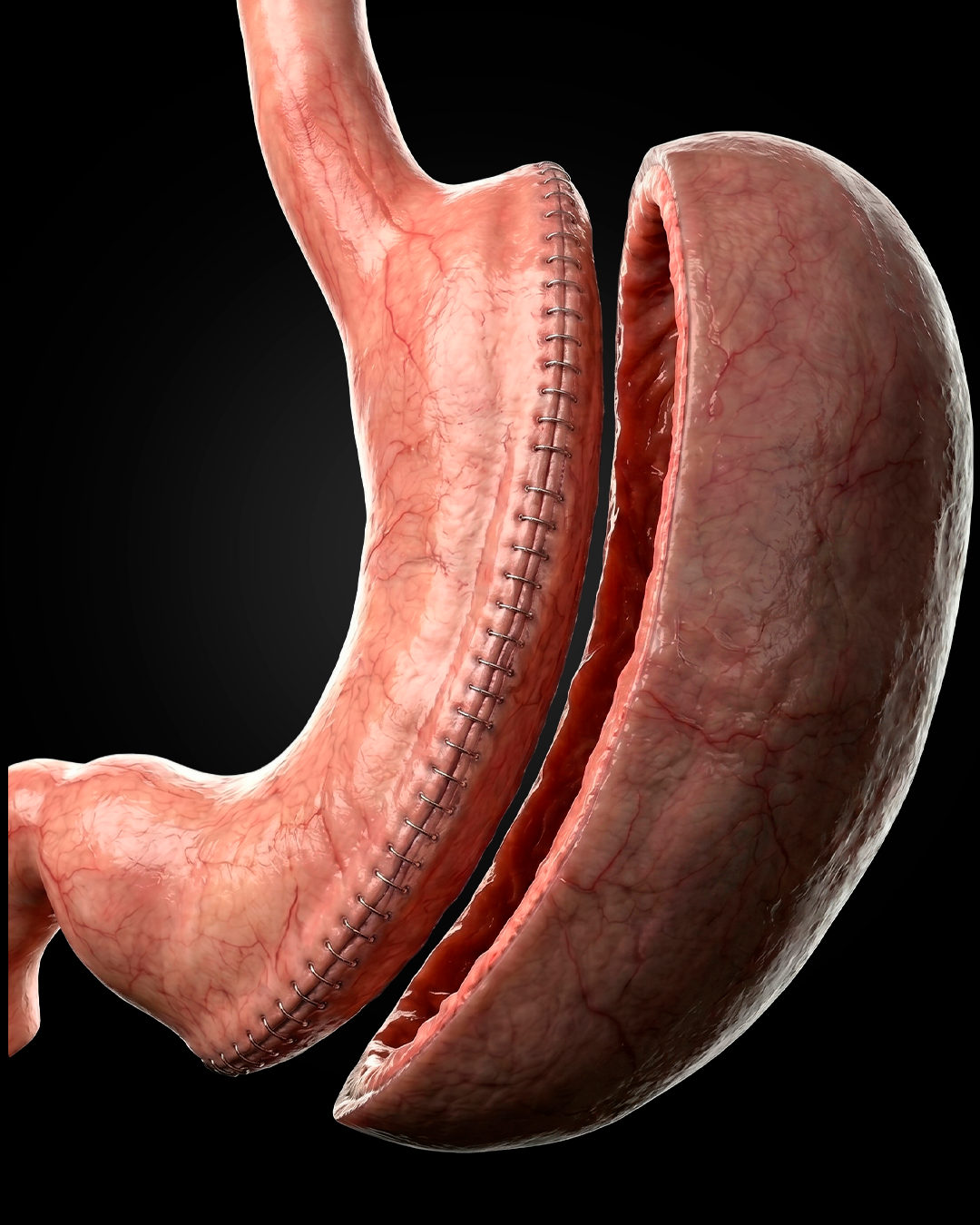 Gastrectomia Vertical — Sleeve
